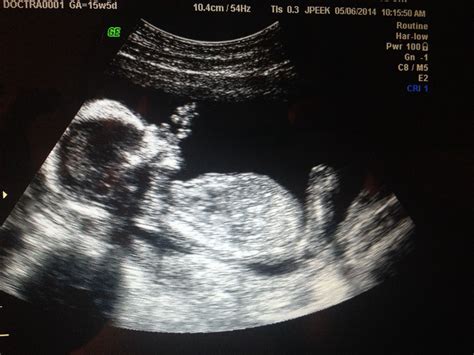 dating scan at 15 weeks